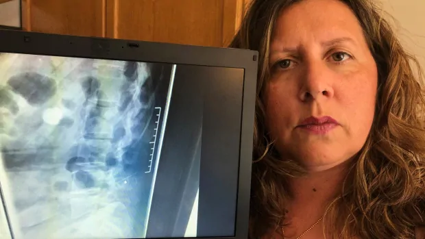 Ontario woman finds needle in her spine 16 years after giving birth