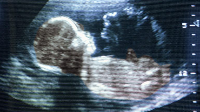 Israel: medical rarity - at birth there is a fetus in the womb of the baby