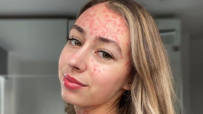 Instagram star Claire Spurgin is aggressively dealing with her illness