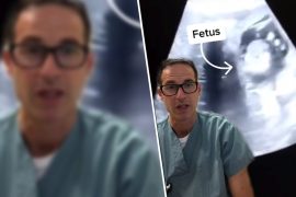 Doctor can hardly believe his eyes: a woman has a fetus in her liver