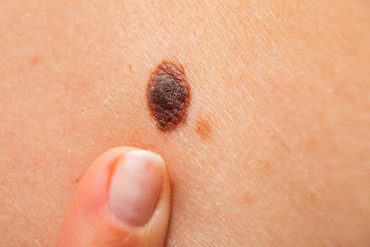 Fight aggressive skin cancer with killer cells