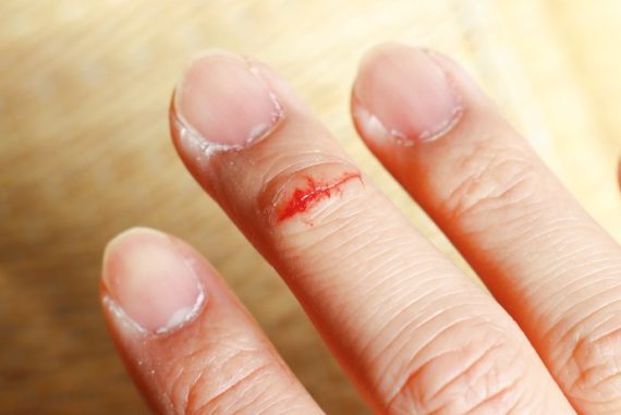 Raggeds: how painful skin cracks develop