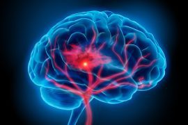 Stroke with an unclear cause often triggered by embolism