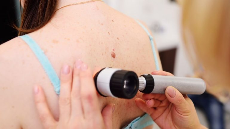Symptoms of Skin Cancer: Lumps and Sores!  You should pay attention to these warning signs
