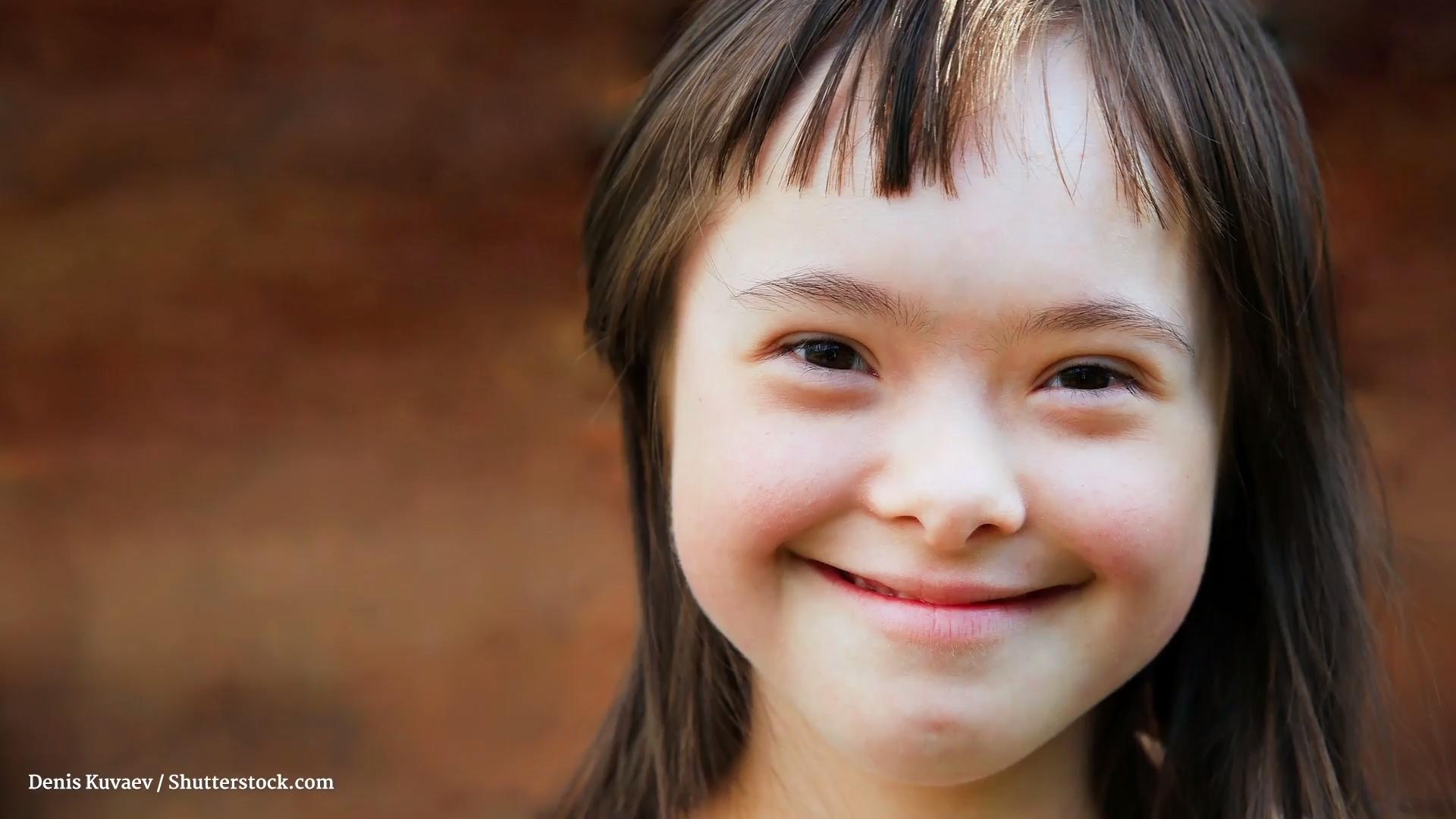 What is Down Syndrome?  trisomy 21