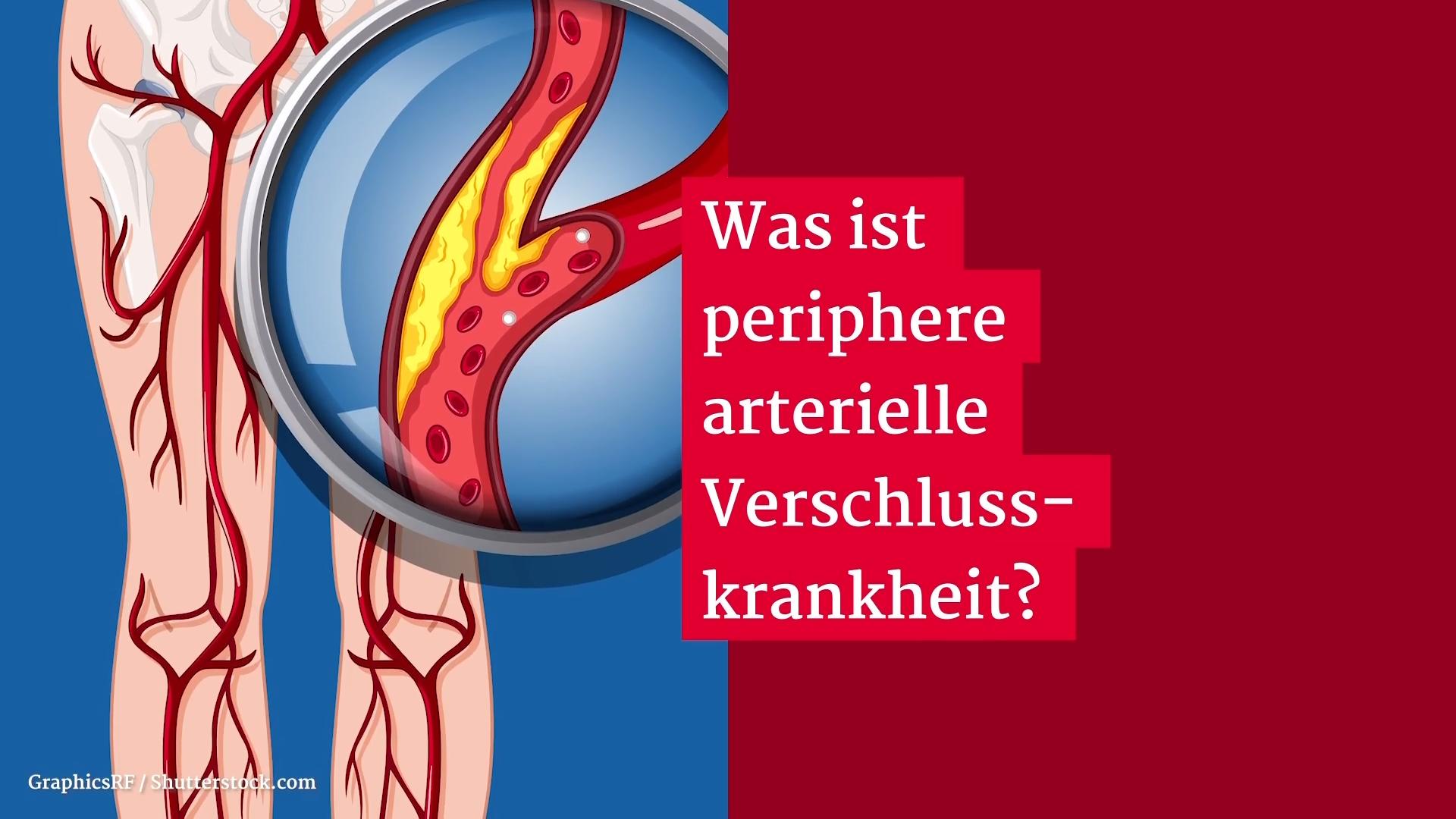 What is Peripheral Artery Disease PAD?