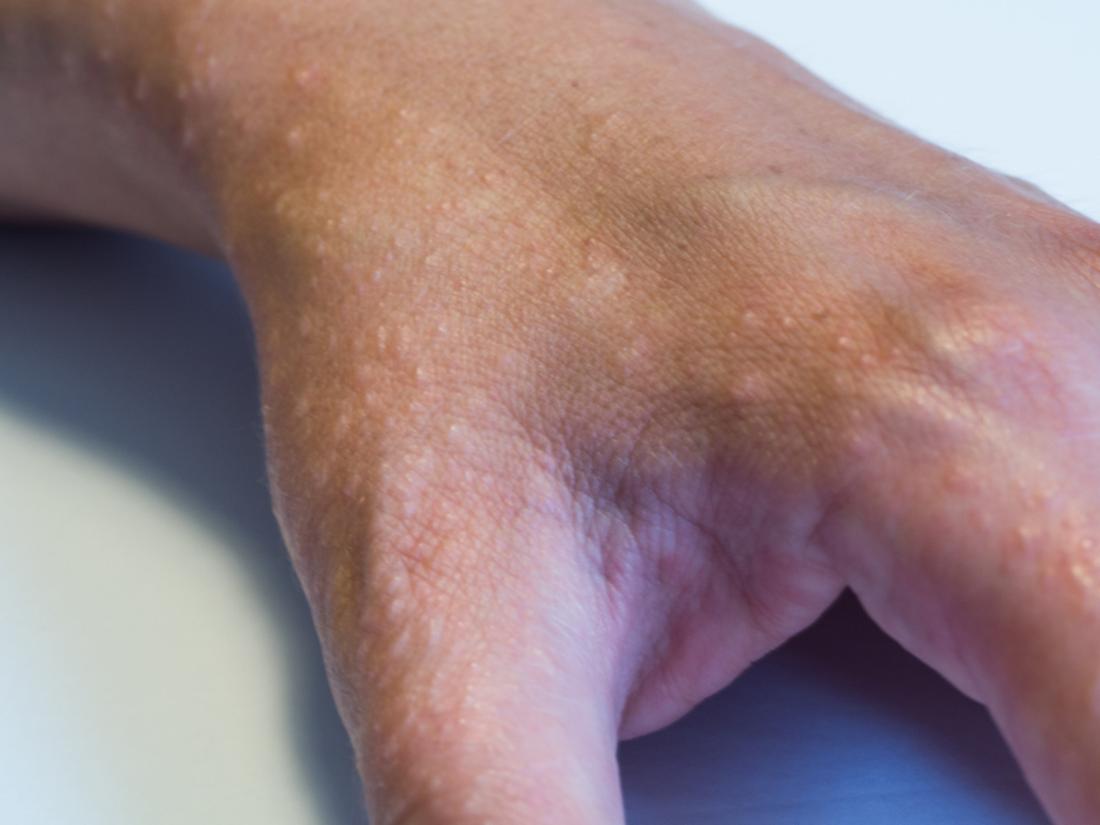 One hand is covered with a small swelling caused by an allergy to the sun.