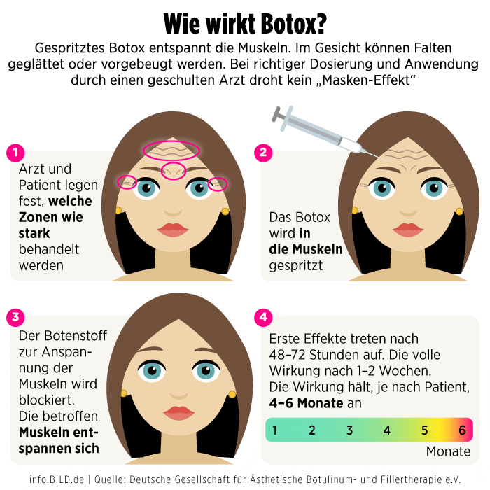 How does Botox work?  ,  info.bild.de infographic