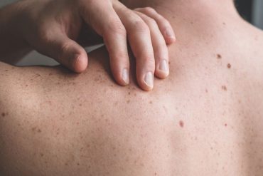 Using the ABCDE Rule: How to Check Your Body for Skin Cancer